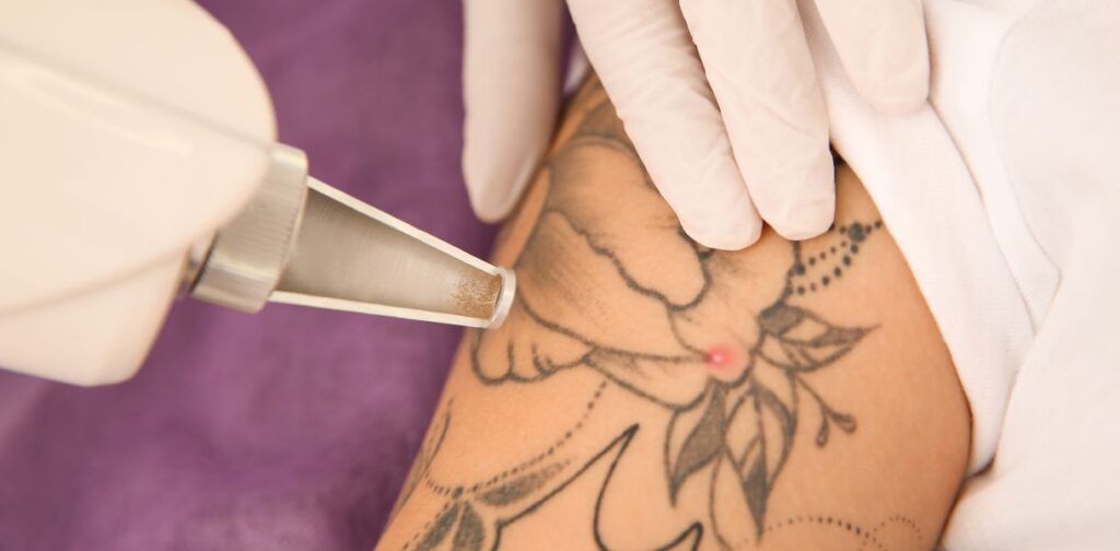 como funciona eliminacion de tatuajes