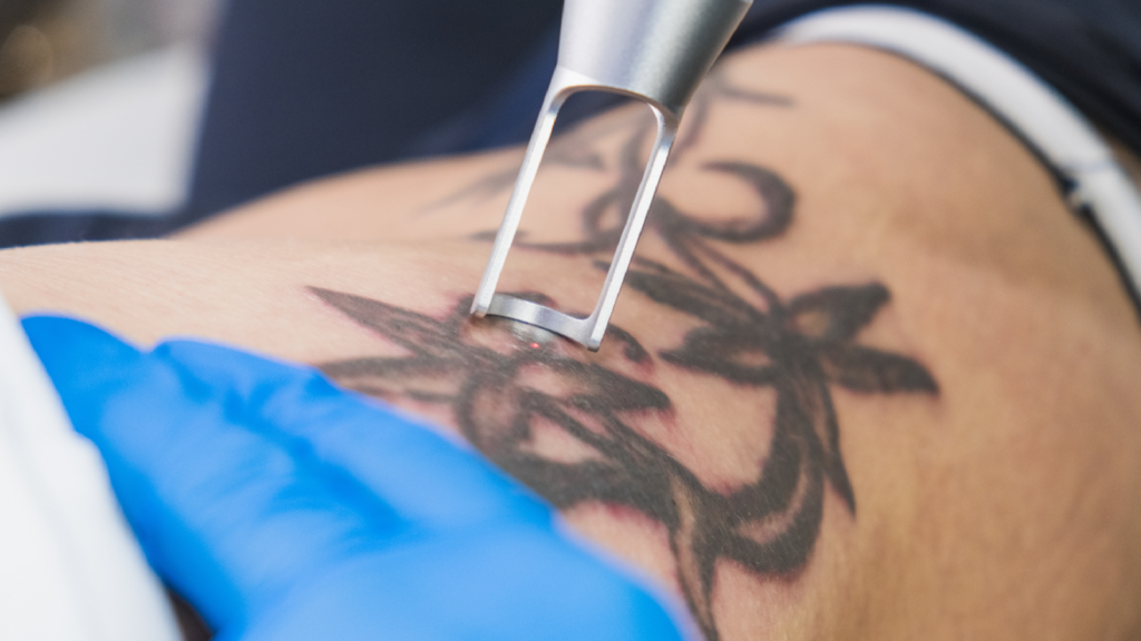 como funciona la eliminacion de tatuajes